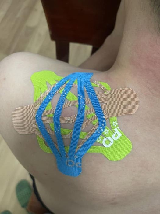 Kinesio Tape vùng vai