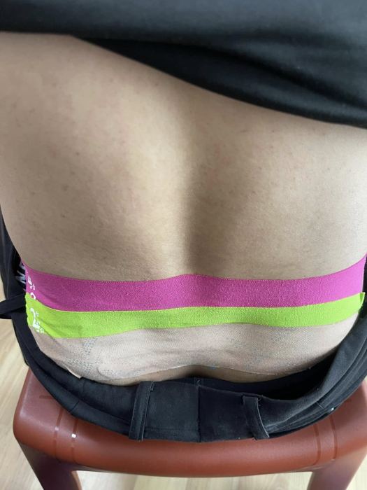 Kinesio Tape vùng thắt lưng