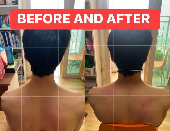 Vai và lưng cân đối hơn sau trị liệu