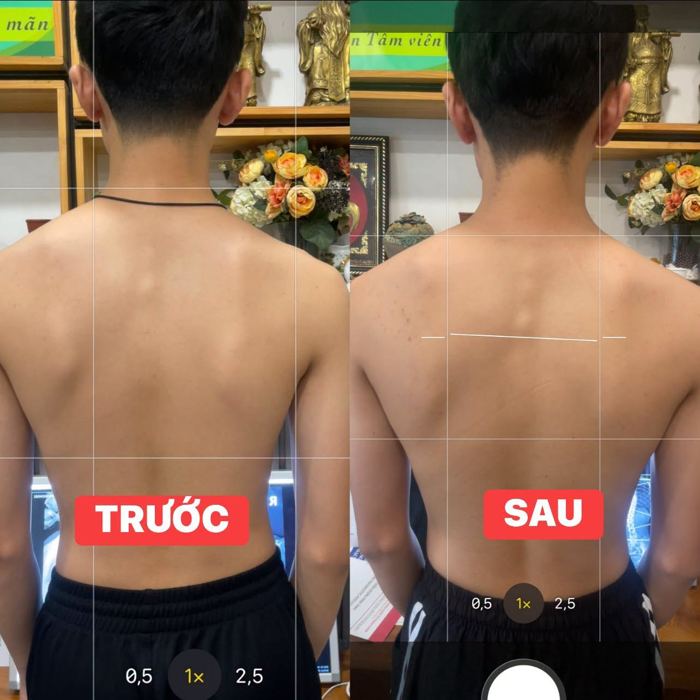 Lưng trước và sau trị liệu