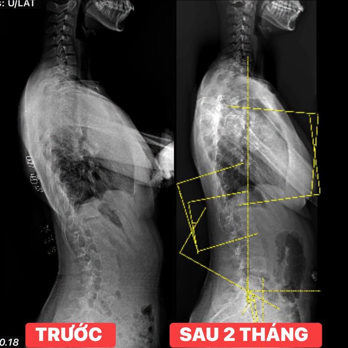 Phim nghiêng trước và sau 2 tháng