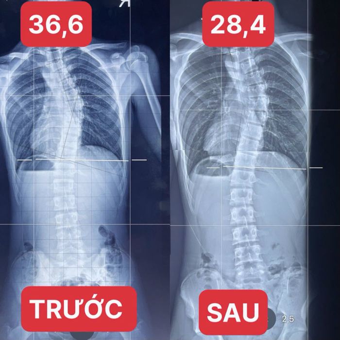 X-quang: góc vẹo 36,6° → 28,4°