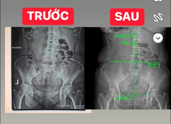 Cột sống thắt lưng trước và sau