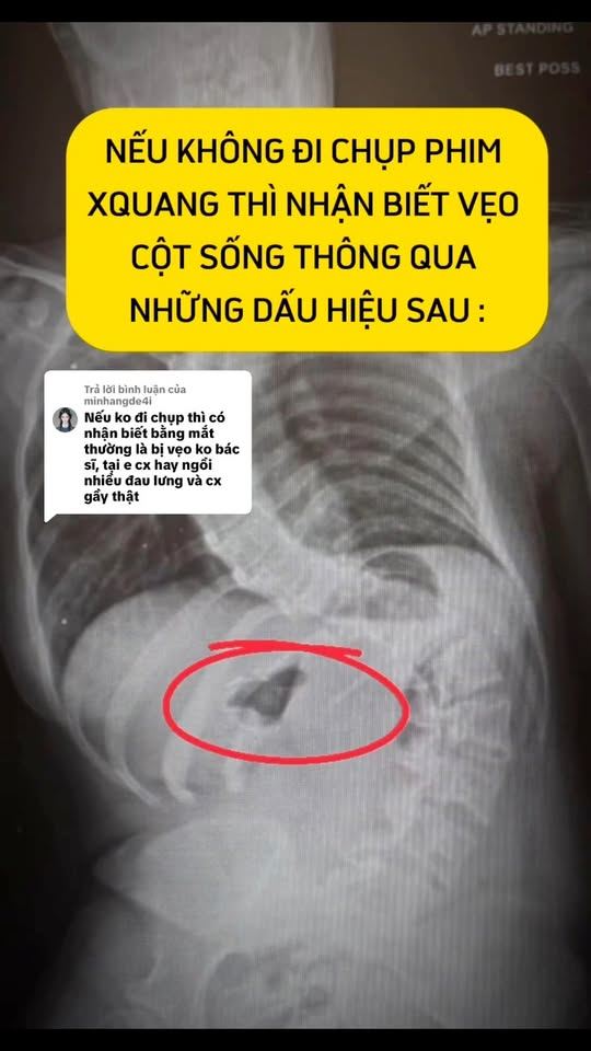 Dấu hiệu vẹo cột sống thực sự khi chưa có phim X-quang