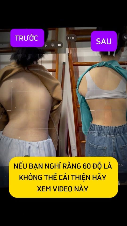 Nghĩ rằng vẹo 60 độ không cải thiện được? Hãy xem video này