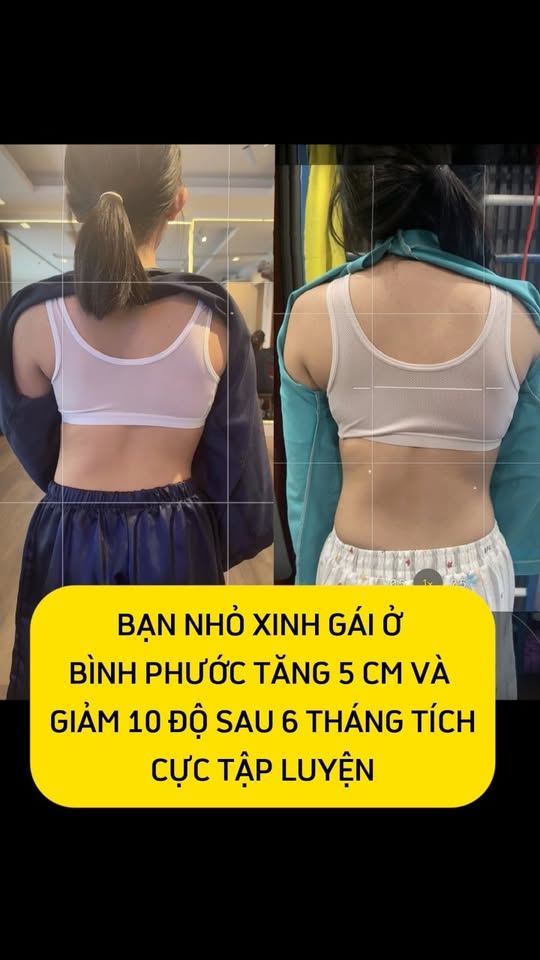 Giảm 10 độ và tăng 5 cm sau 6 tháng tập phục hồi