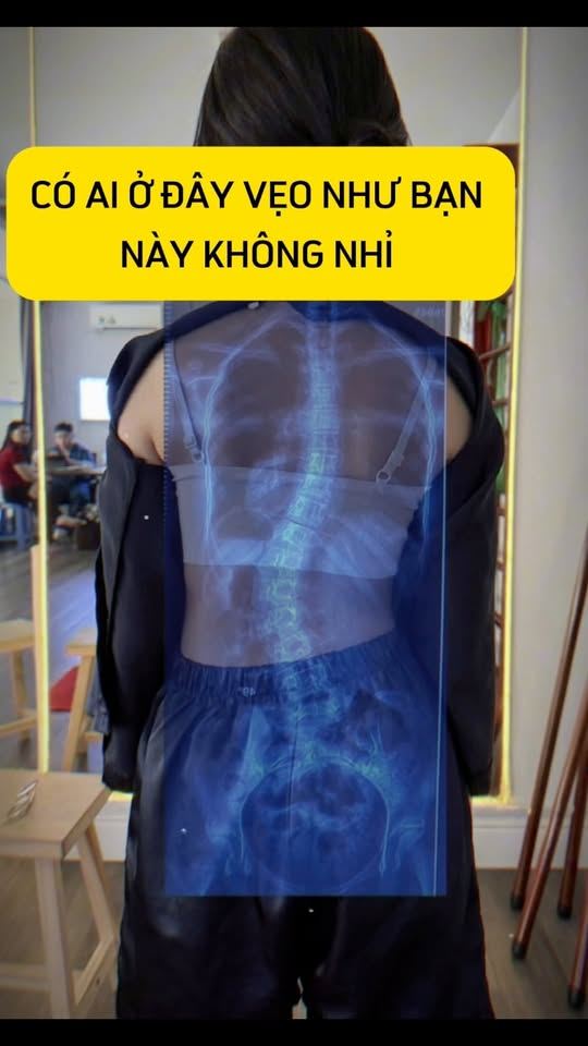 Dạng vẹo rất điển hình và bài tập đặc hiệu cho dạng vẹo đó