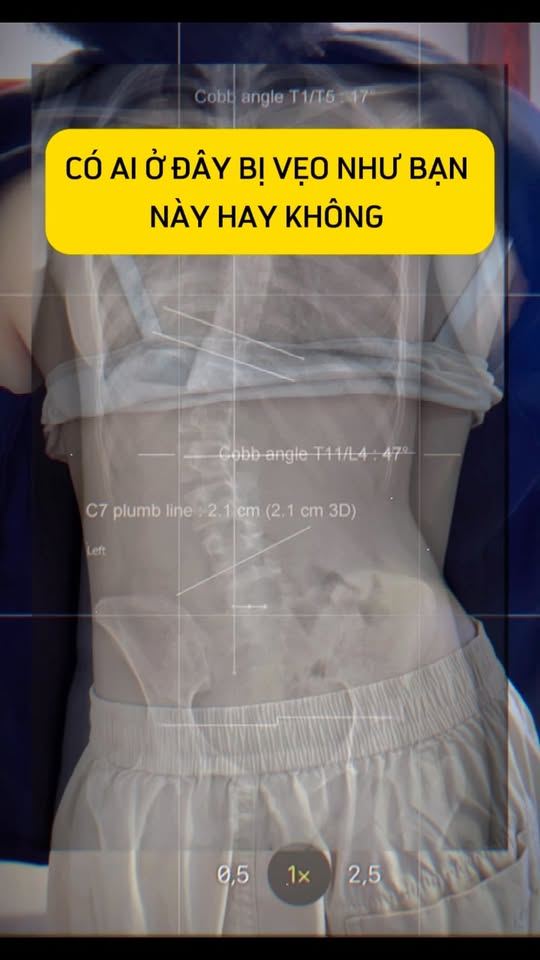 Có ai ở đây bị vẹo cột sống như bạn này không?